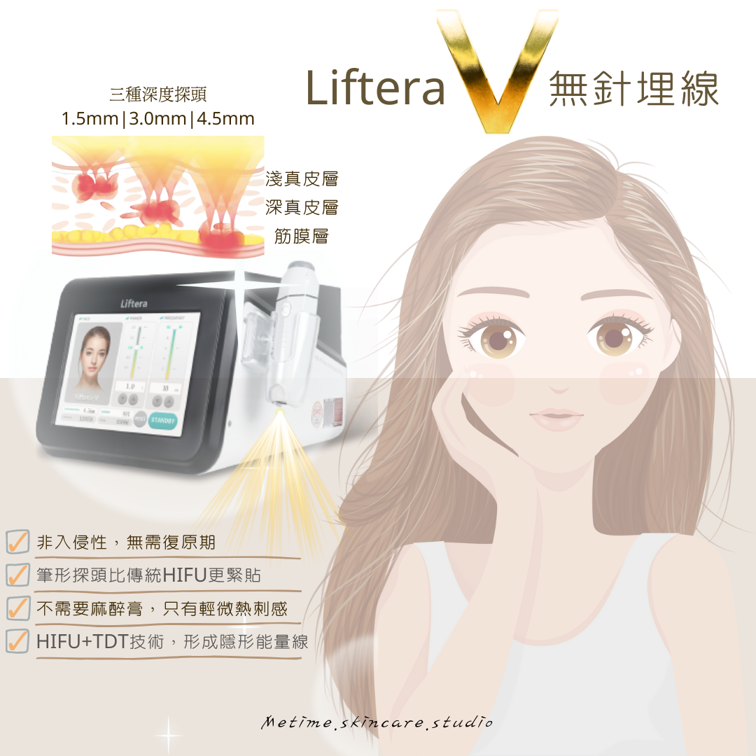 Liftera V 無針埋線