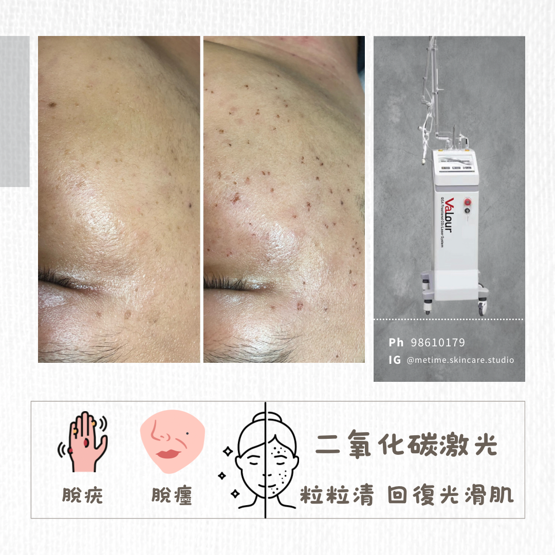 Co2 laser