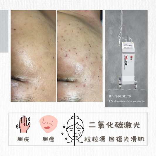 Co2 laser