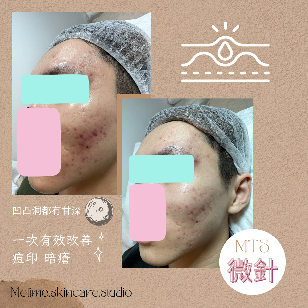 MTS皇牌微針療程